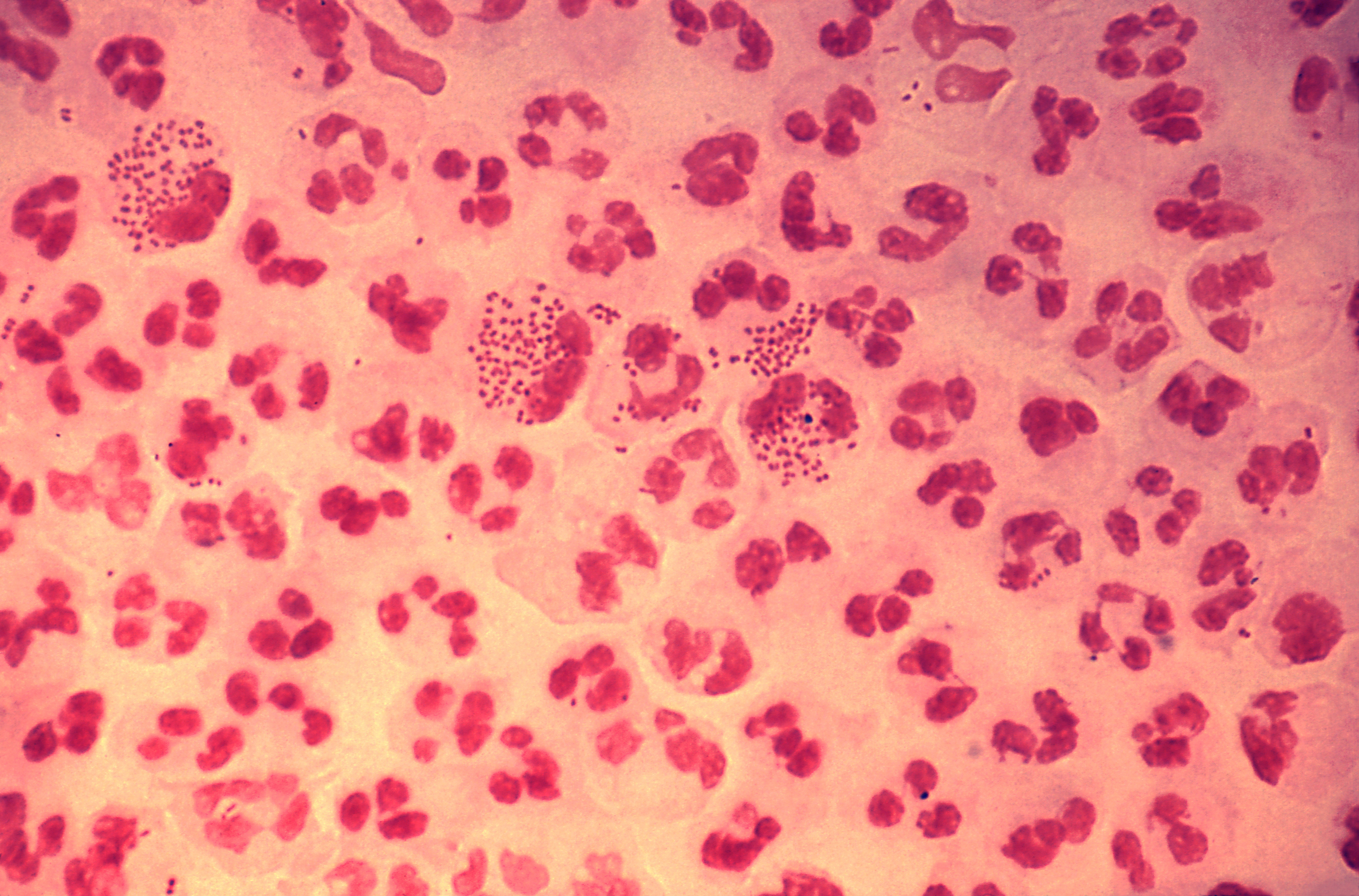 ¡Nueva publicación sobre infecciones extra-genitales por gonococo resistente a quinolonas!