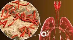 ¡Nueva publicación sobre la estimación de la carga por tuberculosis en Pakistan!