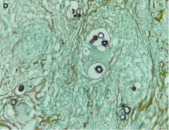 ¡Nueva publicación sobre paracoccidioidomicosis!